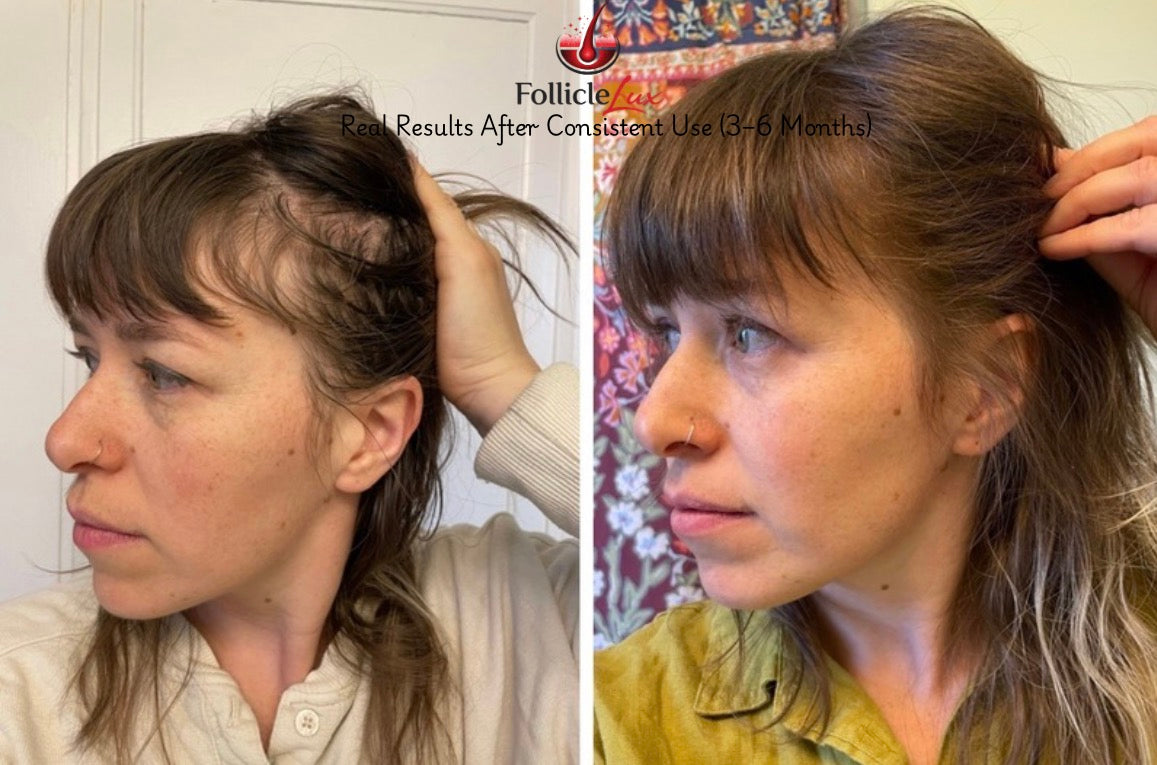 LumiComb Red Light Scalp Therapy Comb