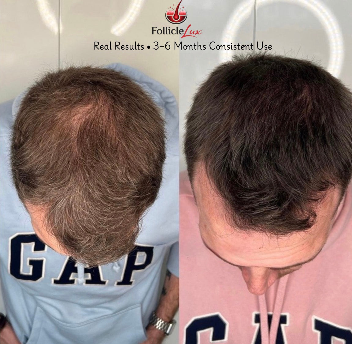 LumiCrown Red Light Therapy Hair Growth Cap